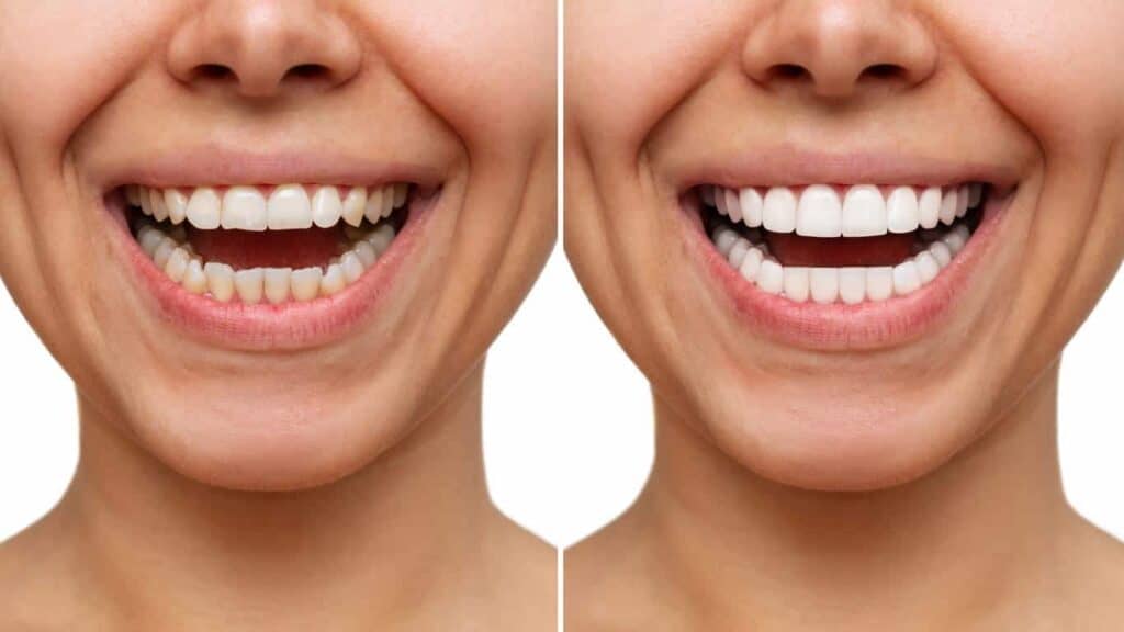 Before and after teeth whitening results. Walsall